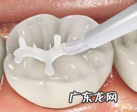 小孩子怎么做窝沟封闭?