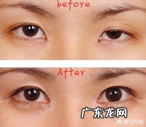 贴双眼皮贴久了能做双眼皮手术吗,后遗症有什么?