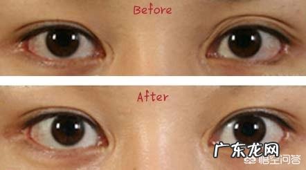 贴双眼皮贴久了能做双眼皮手术吗,后遗症有什么?