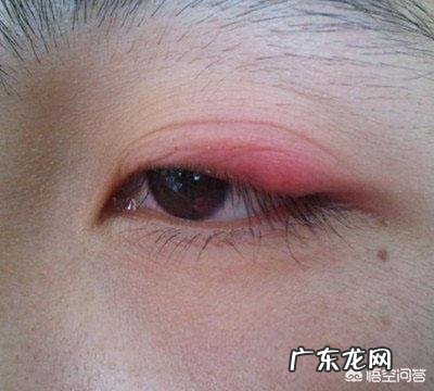 贴双眼皮贴久了能做双眼皮手术吗,后遗症有什么?