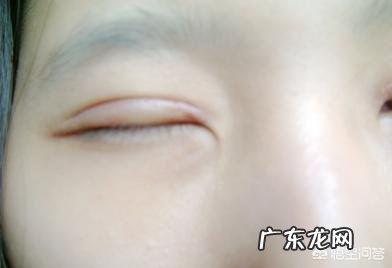 贴双眼皮贴久了能做双眼皮手术吗,后遗症有什么?