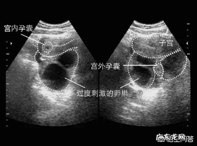 测试纸测的出来宫外孕吗?