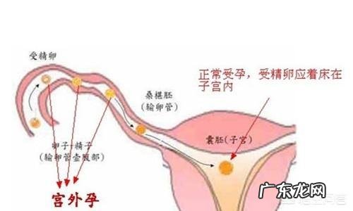 测试纸测的出来宫外孕吗?