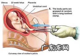 无痛人流怎么做?