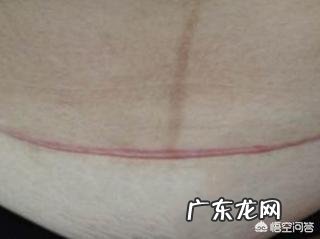 女人生孩子是顺产好?还是剖腹产好?