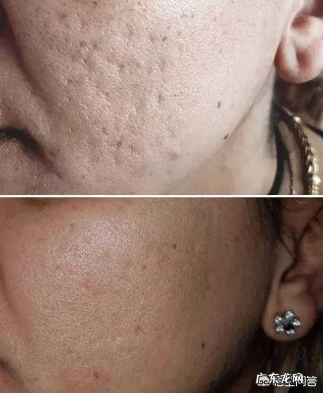 痘痘肌怎样可以不长痘？