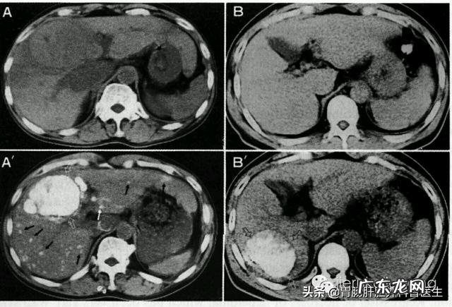 肝开始癌变时,脚底会有3个迹象,若一个不占,肝癌离你还很远!迹象是什么?