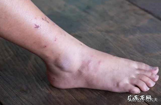 肝开始癌变时,脚底会有3个迹象,若一个不占,肝癌离你还很远!迹象是什么?