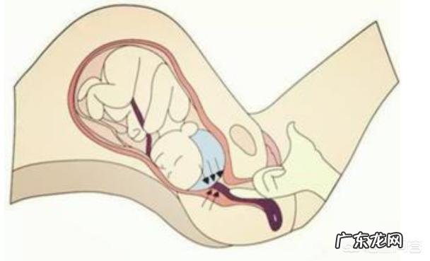 胎盘低是怎么回事？该怎么办？