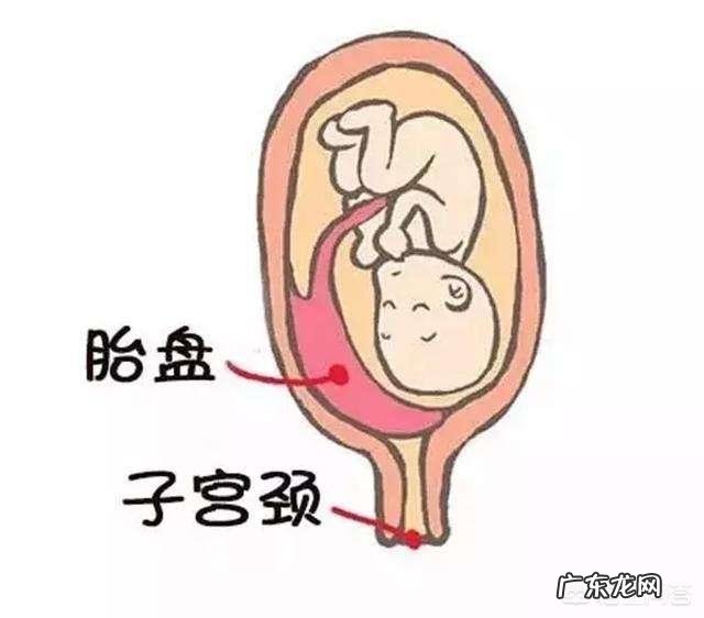 胎盘低是怎么回事?该怎么办?