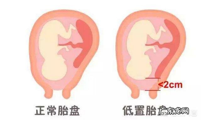 胎盘低是怎么回事?该怎么办?