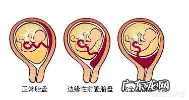 胎盘低是怎么回事？该怎么办？