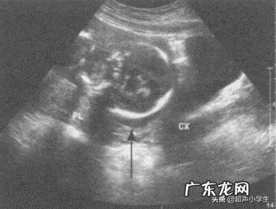 胎盘低是怎么回事?该怎么办?