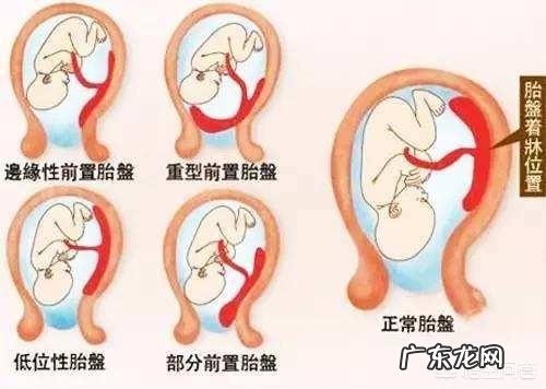 胎盘低是怎么回事？该怎么办？