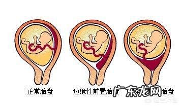 胎盘低是怎么回事?该怎么办?