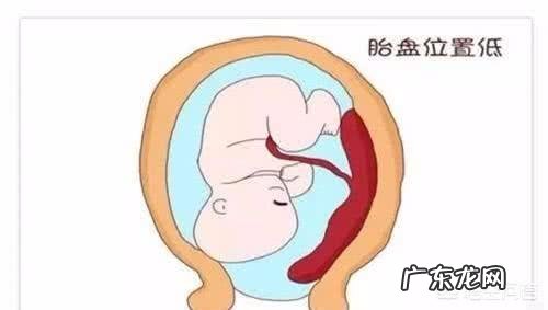 胎盘低是怎么回事?该怎么办?