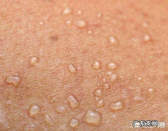 手上总起痒痒的小水泡,到底是咋回事?