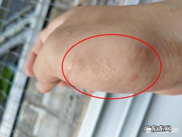 手上总起痒痒的小水泡,到底是咋回事?