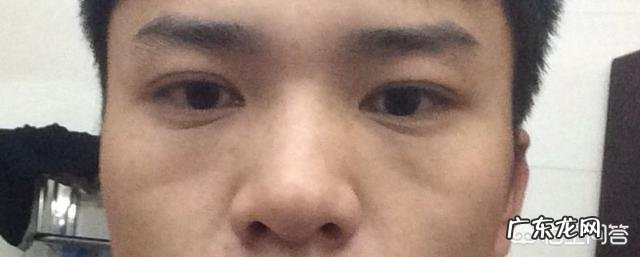 面部印第安纹应该怎么去除?