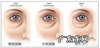 面部印第安纹应该怎么去除?