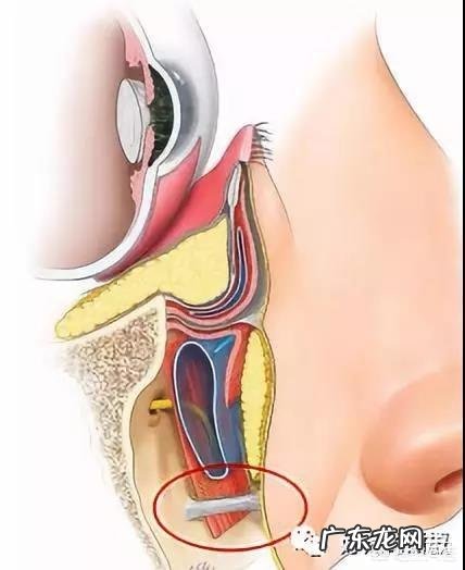 面部印第安纹应该怎么去除?