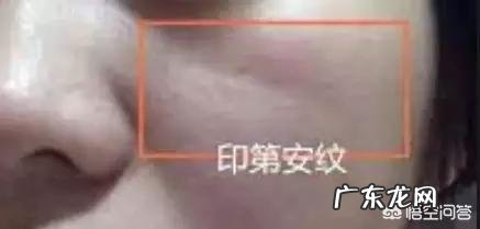 面部印第安纹应该怎么去除？