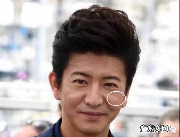 面部印第安纹应该怎么去除?