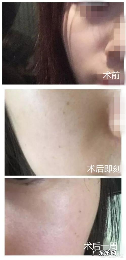 面部印第安纹应该怎么去除?