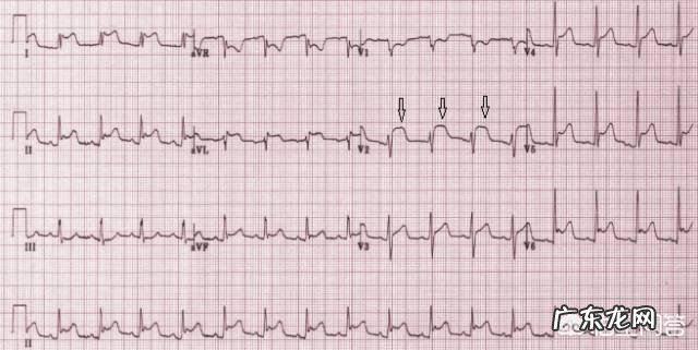 心电图ST段改变,有什么临床意义?