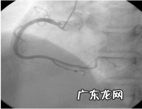 心电图ST段改变,有什么临床意义?