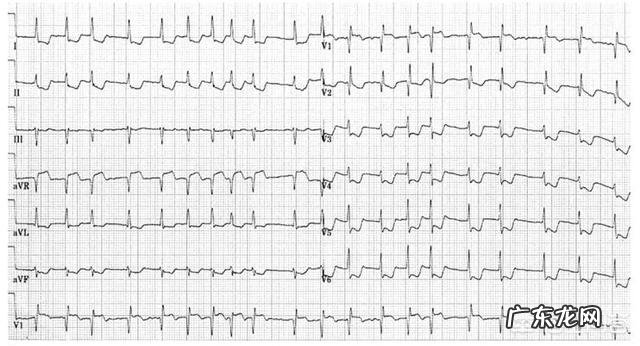 心电图ST段改变，有什么临床意义？