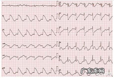 心电图ST段改变,有什么临床意义?