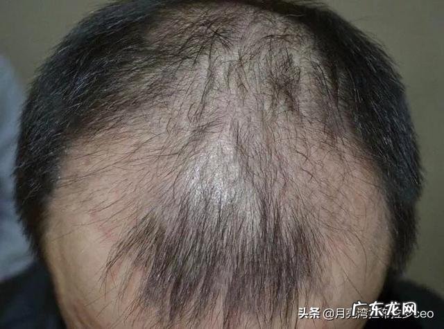 气滞、气虚、痰湿、体寒,都会造成血瘀体质,怎样调理血瘀?