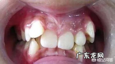 多大年纪做牙齿矫正比较好?