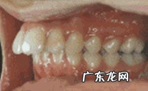 多大年纪做牙齿矫正比较好？