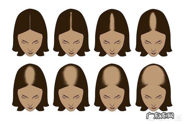 产后脱发严重怎么办?