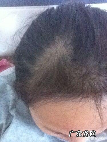 产后脱发严重怎么办?