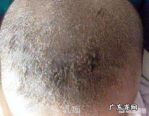 新生儿的囟门如何正确护理?