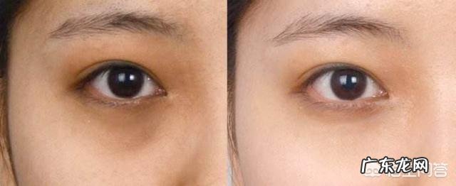 因为熬夜出现黑眼圈和泪沟怎么办?