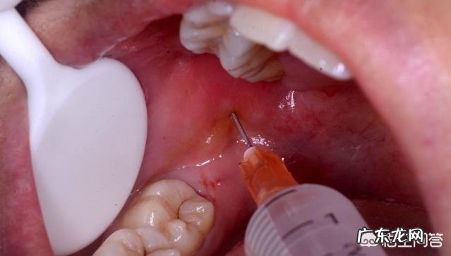 拔智齿疼吗？拔完是什么感觉？