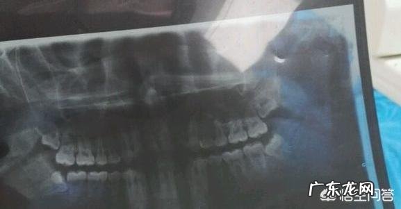 拔智齿疼吗？拔完是什么感觉？