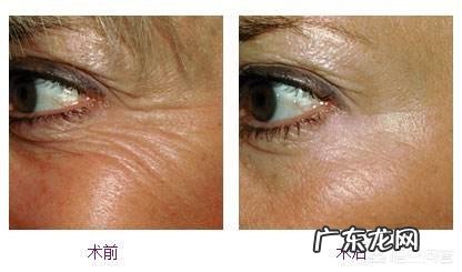 眼角有皱纹该怎么办?