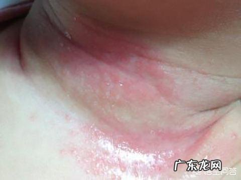 新生儿皮肤护理:胎垢、脱皮、腌脖子、肚脐腋下护理都有哪些?