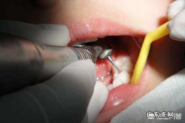 补牙会很疼吗?