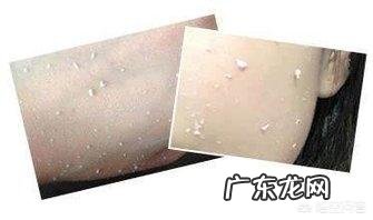 封闭性粉刺和结疤的痘痘怎么去掉?