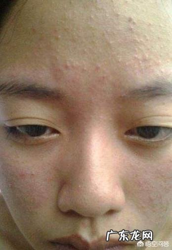 封闭性粉刺和结疤的痘痘怎么去掉?