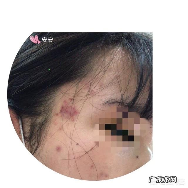 封闭性粉刺和结疤的痘痘怎么去掉?