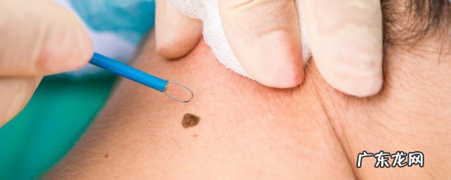 点完痣要注意什么不能吃