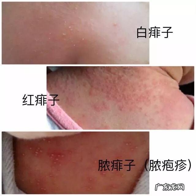 出生的婴儿脸上有小白点是怎么回事?