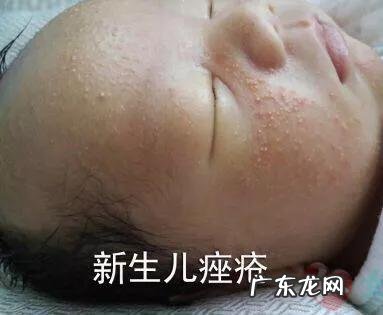 出生的婴儿脸上有小白点是怎么回事?
